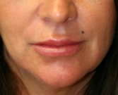 Feel Beautiful - Lip Augmentation San Diego Case 10 - After Photo